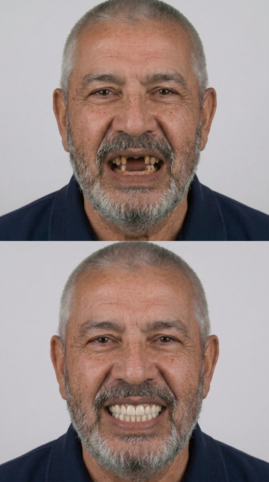 Full face before and after All-on-4 dental implants - male patient