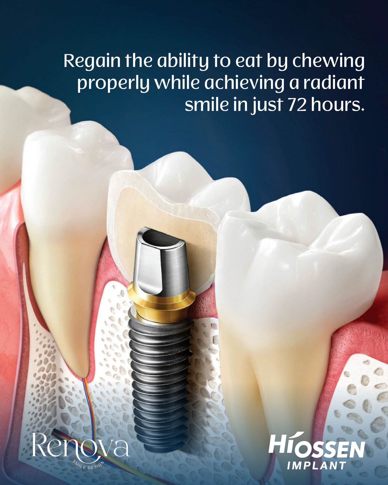 Premium Hiossen implant - regain chewing ability in 72 hours